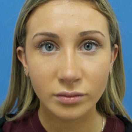 After image 1 Case #102171 - 18 year old - Open Rhinoplasty w/submucous resection/Septoplasty & Spreader grafts to improve airway 