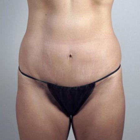 After image 1 Case #103166 - Mini Tummy Tuck Patient 20
