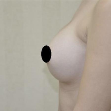 After image 2 Case #103121 - Breast Augmentation 