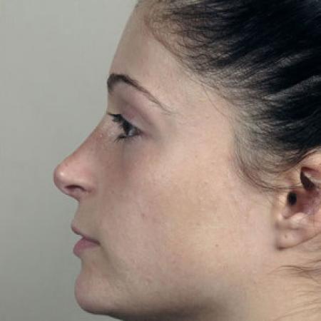 After image 2 Case #103141 - Rhinoplasty Patient 72