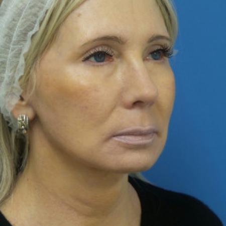 After image 2 Case #102321 - 60 year old  -  Necklift & Facelift  -  3 months post-op