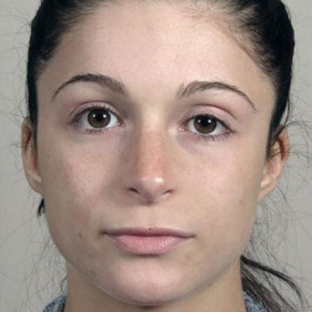 After image 1 Case #103141 - Rhinoplasty Patient 72