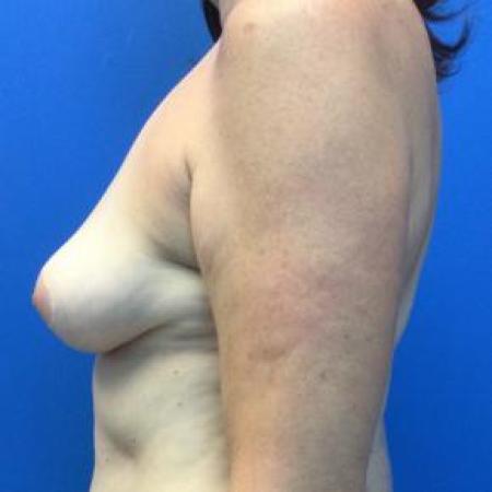 After image 3 Case #103336 - Removal of Implants with Fat Grafting to Breasts for a 50 year old female