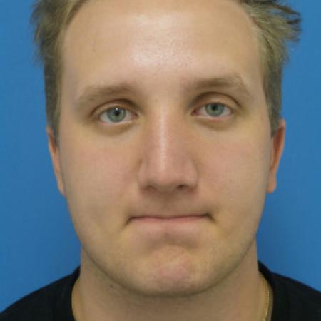 After image 3 Case #102296 - 19 year old  -  Open Septo-Rhinoplasty with Inferior Turbinectomies  -  3 months post-op