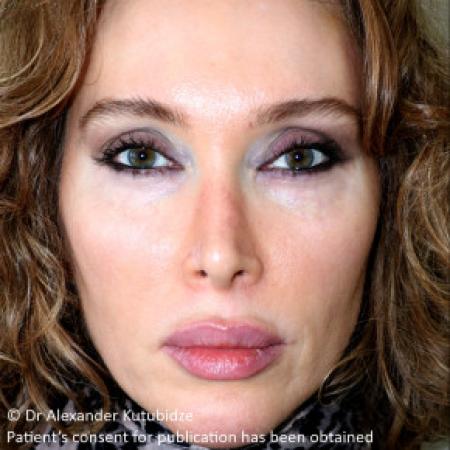 After image 1 Case #103351 - Revision Rhinoplasty. 3 years after