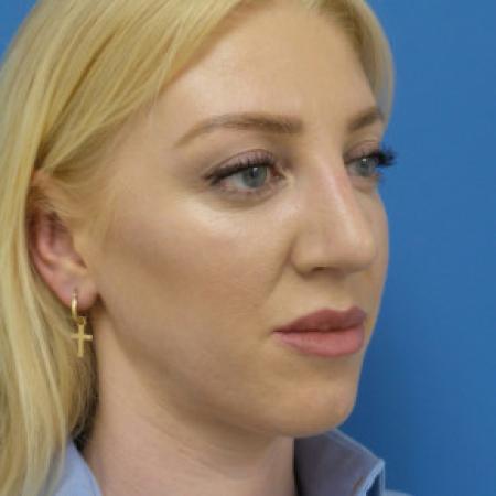 After image 2 Case #102326 - 29 year old  -  Open Rhinoplasty  -  3 months post-op