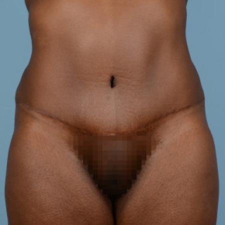 After image 1 Case #103226 - Tummy tuck with liposuction of hiprolls