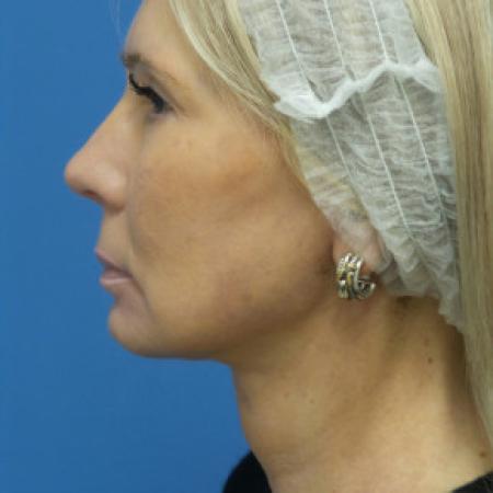 After image 3 Case #102321 - 60 year old  -  Necklift & Facelift  -  3 months post-op