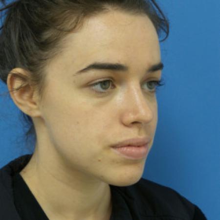 After image 2 Case #102236 - 22 year old  -  Open Rhinoplasty  -  3 months post-op