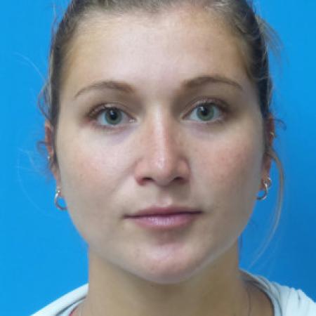 After image 1 Case #102306 - 25 year old  -  Open Rhinoplasty  -  6 months post-op