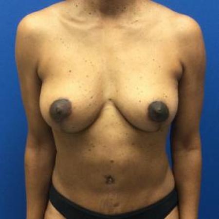 After image 1 Case #103306 - Mastopexy with autologous fat grafting to breasts and aAbdominoplasty for a 45 year old female