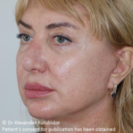 After image 3 Case #103361 - Deep Plane Face Lifting