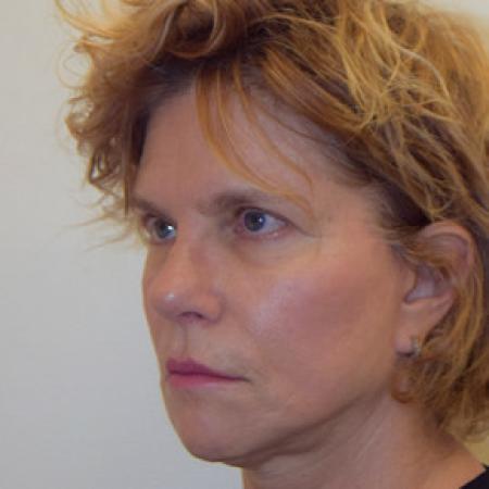After image 2 Case #101576 - Facelift