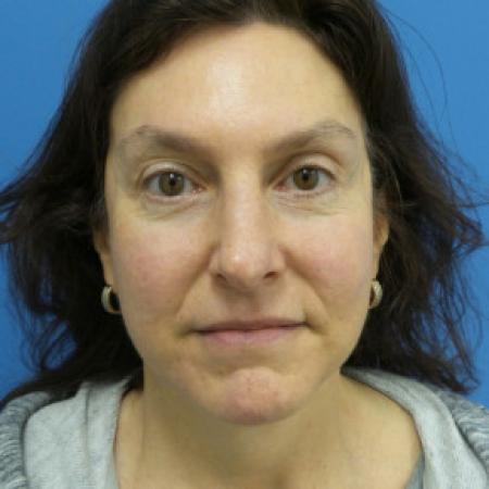 After image 1 Case #102181 - 58 year old  -  Browlift/Facelift/Lower Blepharoplasty/TCA Peel  -  10 months post-op