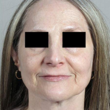 After image 1 Case #103151 - Rhinoplasty Patient 58