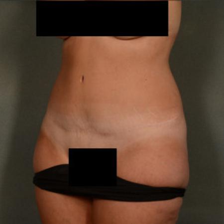 After image 2 Case #101591 - Abdominoplasty