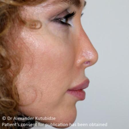 After image 5 Case #103351 - Revision Rhinoplasty. 3 years after