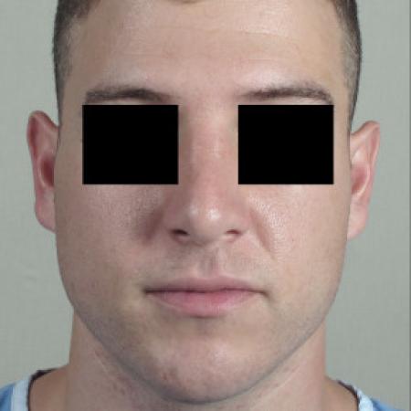 After image 1 Case #103126 - Rhinoplasty Patient 75