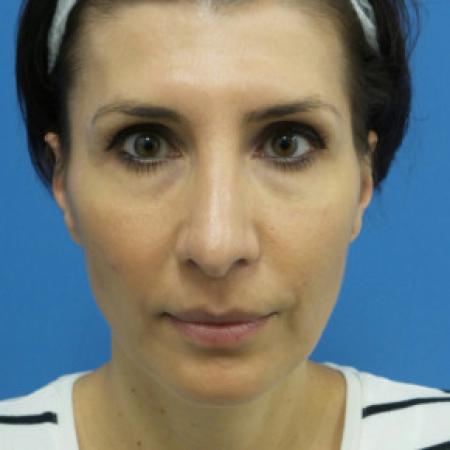 After image 1 Case #102201 - 42 year old - Open Septo Rhinoplasty  -  7 months post-op