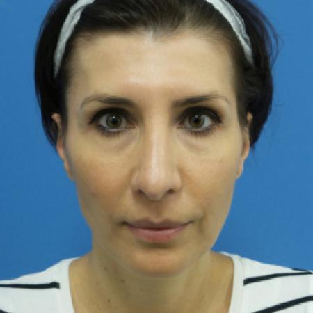 After image 3 Case #102201 - 42 year old - Open Septo Rhinoplasty  -  7 months post-op
