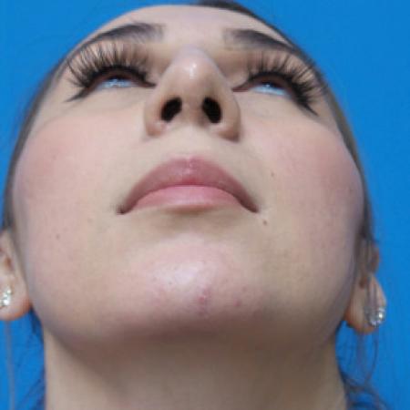 After image 4 Case #102206 - 30 year old  -  Open Rhinoplasty & Chin Augmentation   3 months post-op