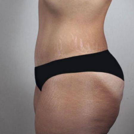 After image 2 Case #103161 - Tummy Tuck Patient 61