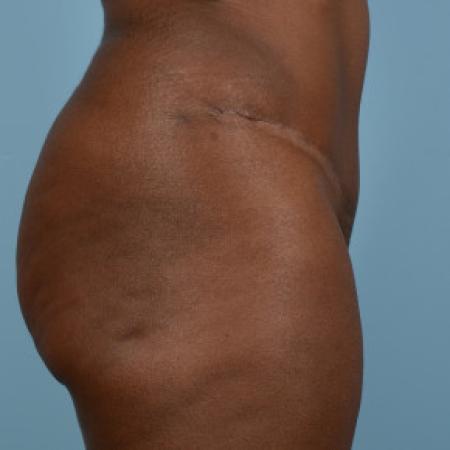 After image 2 Case #103226 - Tummy tuck with liposuction of hiprolls