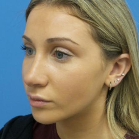 After image 2 Case #102171 - 18 year old - Open Rhinoplasty w/submucous resection/Septoplasty & Spreader grafts to improve airway 