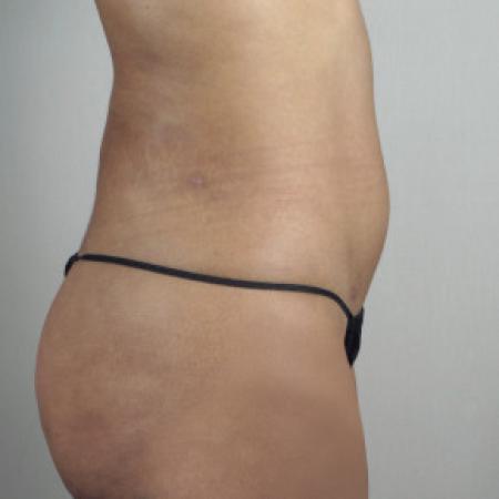After image 2 Case #103181 - Liposuction of the Hips Patient 30