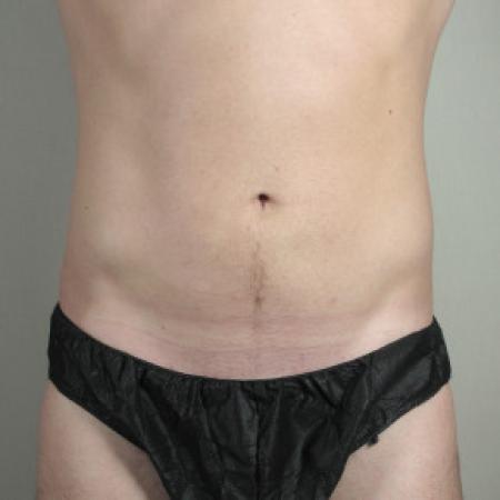 After image 1 Case #103131 - Liposuction of the Abdomen & Flanks Patient 70