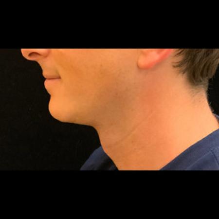 After image 1 Case #101561 - CHIN IMPLANT