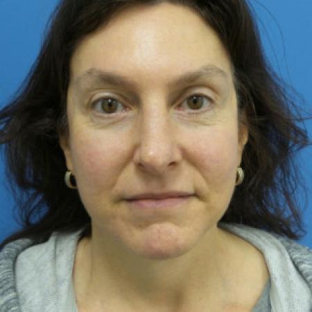 After image 1 Case #102176 - 58 year old  -  Facelift/Browlift/Lower Blepharoplasty/TCA Peel  -  10 months post-op