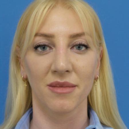 After image 1 Case #102326 - 29 year old  -  Open Rhinoplasty  -  3 months post-op