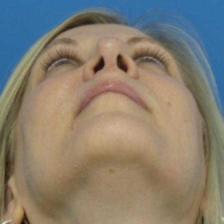 After image 4 Case #102241 - 56 year old  -  Open Rhinoplasty/Septoplasty/Turbinectomy  -  5 months post-op