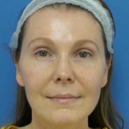 After image 1 Case #102231 - 39 year old  -  Endoscopic Browlift    5 months post-op