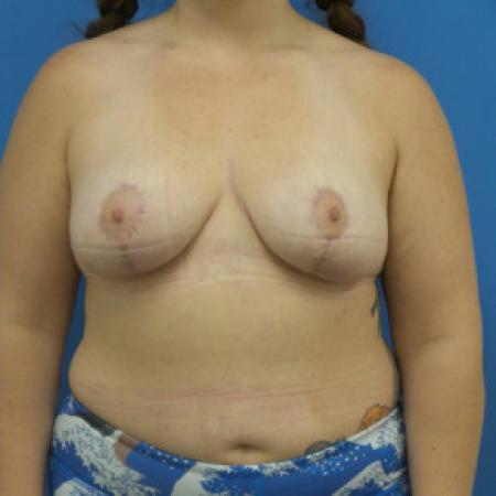 After image 1 Case #102291 - 29 year old  -  Bilateral Breast Lift  -  4 months post-op