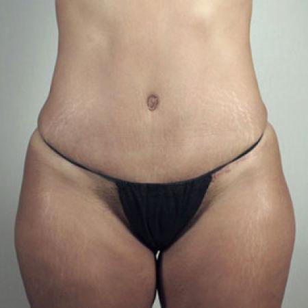 After image 4 Case #103186 - Mommy Makeover Patient 30 