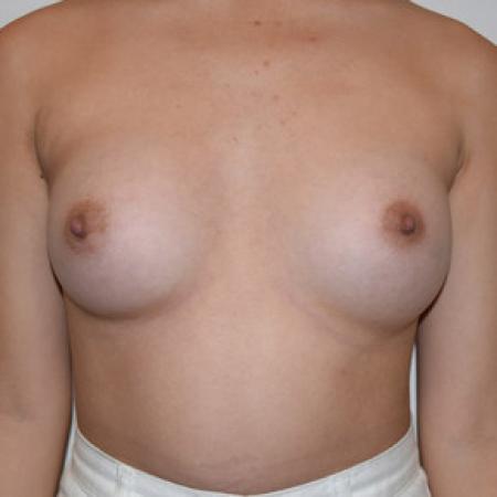 After image 1 Case #101581 - Breast Augmentation