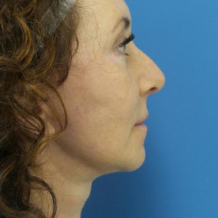 After image 3 Case #102266 - 55 year old  -  Facelift  -  2 months post-op