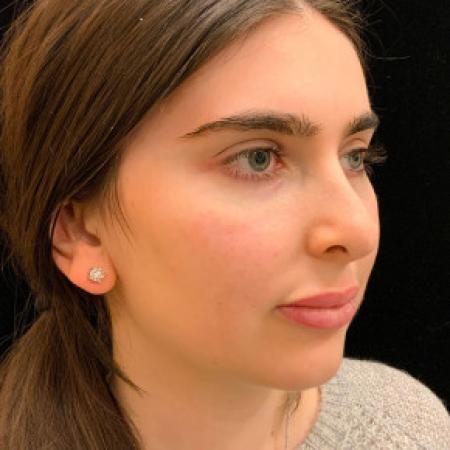 After image 1 Case #101571 - Rhinoplasty