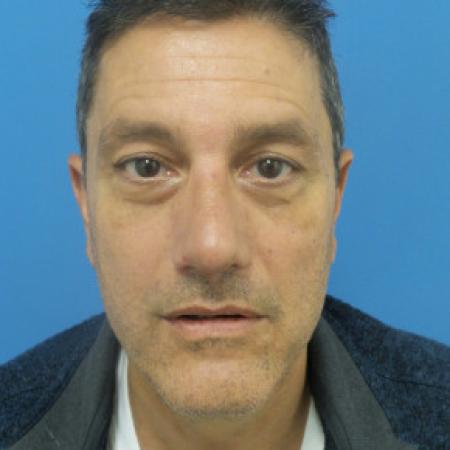 After image 1 Case #102161 - 54 year-old  -  Rhinoplasty/Septoplasty/Turbinectomy   4 weeks post-op