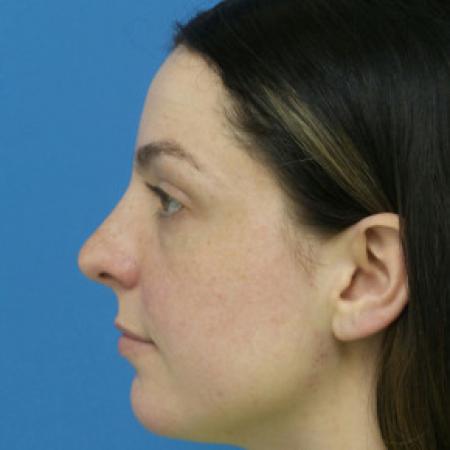 After image 3 Case #102211 - 30 year old  -  Closed Rhinoplasty/Septoplasty/Turbinectomy  -  3 months post-op