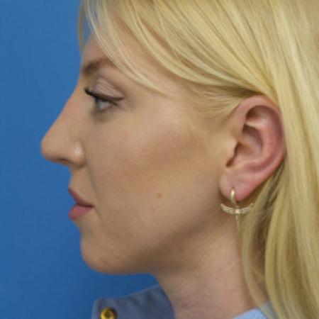 After image 3 Case #102326 - 29 year old  -  Open Rhinoplasty  -  3 months post-op