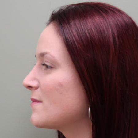 After image 2 Case #103391 - Rhinoplasty