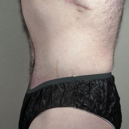After image 2 Case #103176 - Tummy Tuck / Body Lift Patient 1