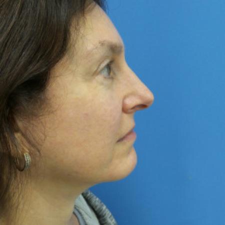 After image 3 Case #102176 - 58 year old  -  Facelift/Browlift/Lower Blepharoplasty/TCA Peel  -  10 months post-op
