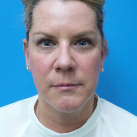 After image 1 Case #102331 - 52 year old  -  Facelift/Neck Lift/Upper Blepharoplasty  - 3 months post-op