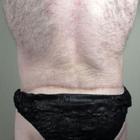 After image 3 Case #103176 - Tummy Tuck / Body Lift Patient 1