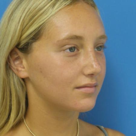 After image 2 Case #102301 - 17 year old  -  Open Septo-Rhinoplasty  -  3 months post-op