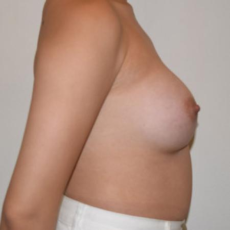 After image 3 Case #101581 - Breast Augmentation